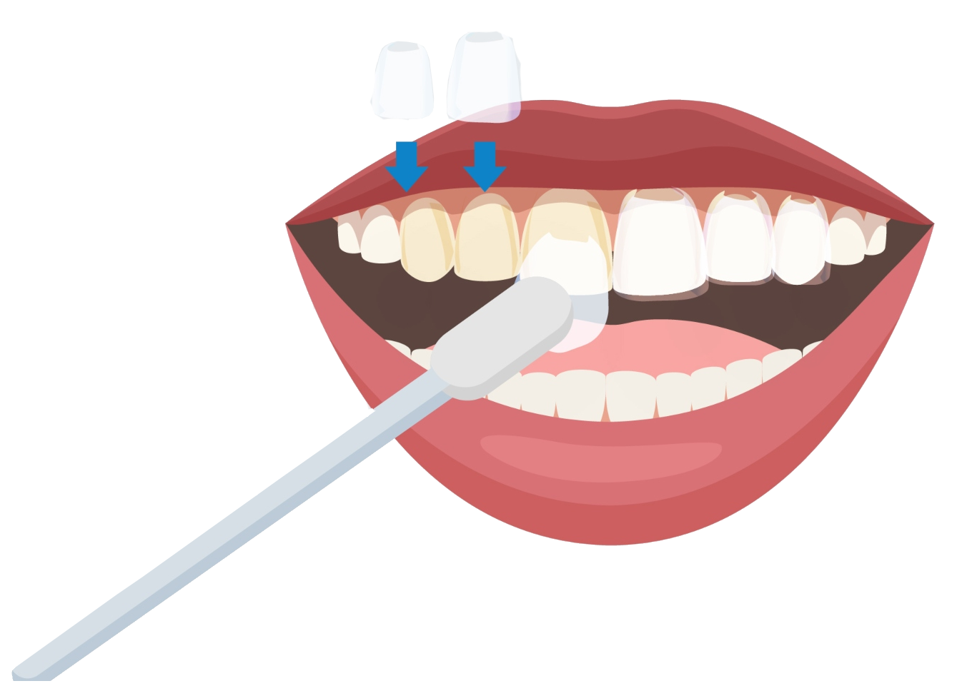 Veneers